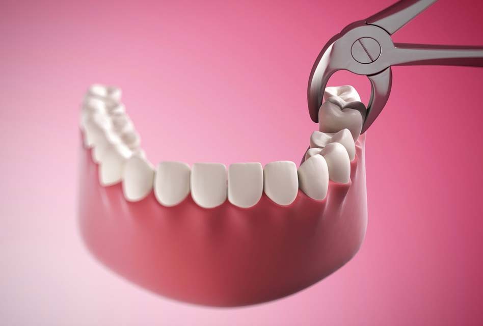 Có nên nhổ răng khôn khi đang bị đau không?