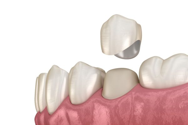 Cách xử lý răng bọc sứ lâu năm bị đau nhức