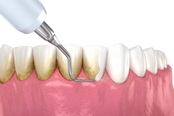 Lấy cao răng có bị mòn răng không?
