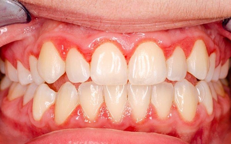 Răng bọc sứ bị chảy máu: Nguyên nhân và cách khắc phục