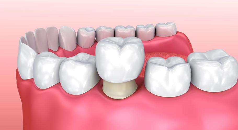 Phân biệt Răng sứ Zirconia và răng sứ Titan