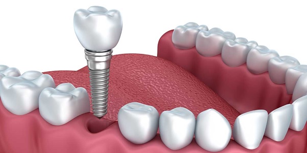 Trụ Trồng răng Implant tốt nhất | Implant Cần Thơ