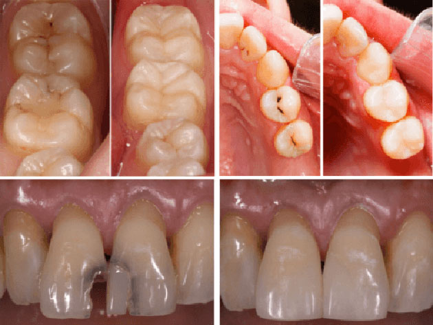 Trám răng thẩm mỹ khác gì với trám răng thông thường | Trám Răng Cần Thơ