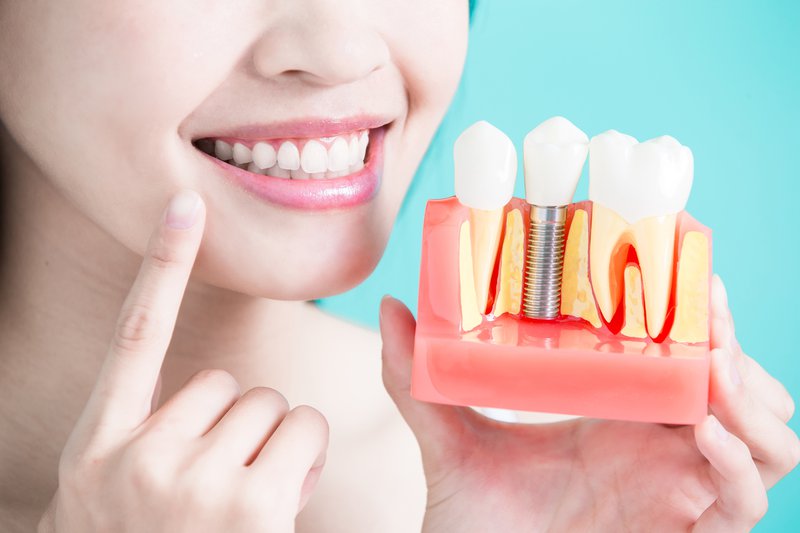 Hướng dẫn chăm sóc răng sau cấy implant | Implant Cần Thơ