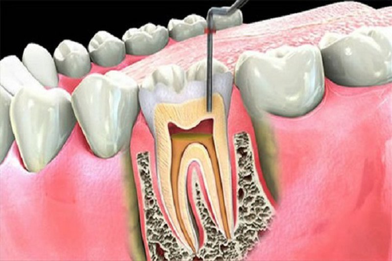 Bảng giá chữa tủy răng tại Nha khoa Cần Thơ Ts Lâm