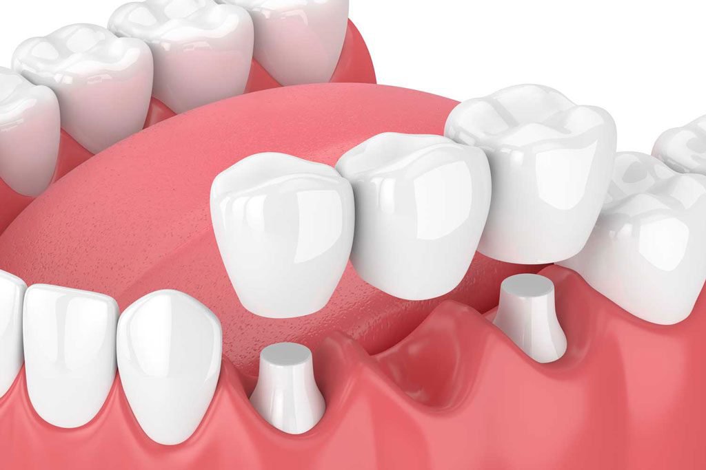 Phục hình răng là gì? Phương pháp phục hình răng