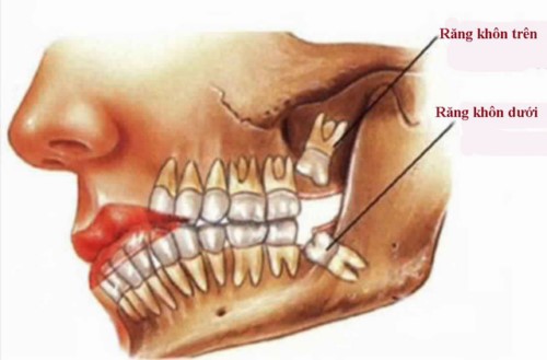 Phân Biệt Giữa Răng Cấm Và Răng Khôn | Nha Khoa Cần Thơ