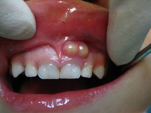Bệnh Áp xe chân răng là gì? Nha Khoa Cần Thơ