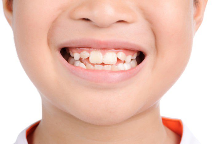 Tại sao răng lại mọc lệch? Niềng Răng Cần Thơ