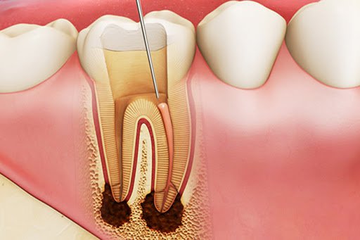 Các cấp độ bệnh lý của tuỷ răng | Nha Khoa Cần Thơ