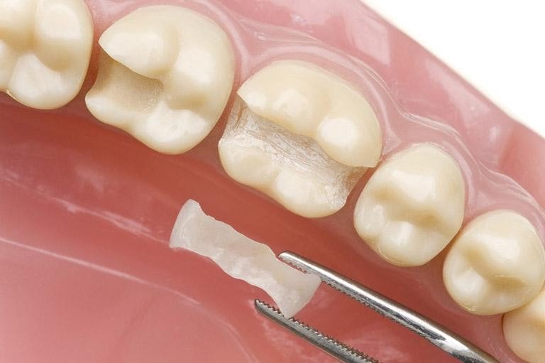 Những trường hợp nào cần hàn răng | Nha Khoa Cần Thơ