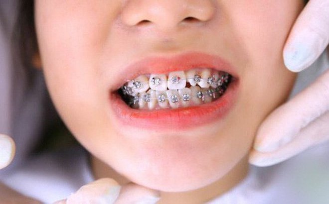Lợi ích khi niềng răng sớm | Niềng răng Cần Thơ
