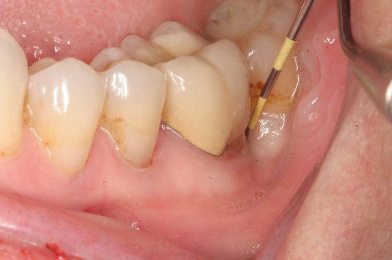 Tiêu quanh răng điều trị thế nào? Nha Khoa Cần Thơ