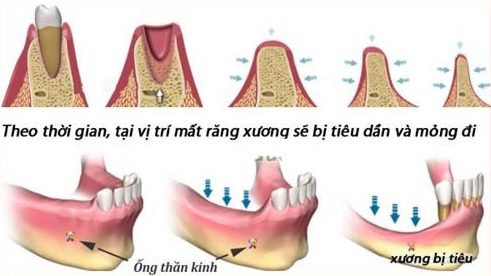 Tiêu xương hàm răng gây ảnh hưởng gì?