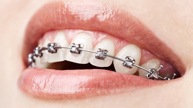 Tại sao niềng răng mắc cài kim loại