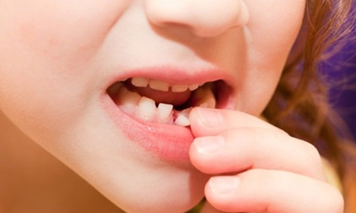 Nhổ răng sữa còn sót chân răng phải làm thế nào?
