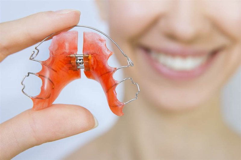 Cách vệ sinh hàm duy trì sau khi niềng răng