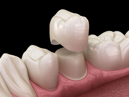 Có nên bọc răng sứ thẩm mỹ cho hàm hô hay không?