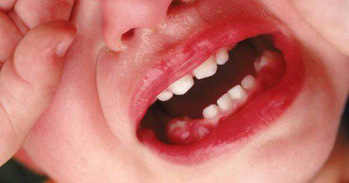 Viêm nướu răng ở trẻ em | Nha khoa trẻ em cần Thơ