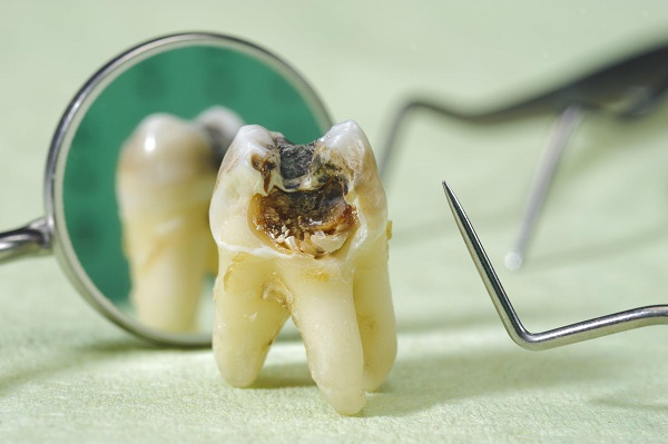 Nguyên nhân & cách điều trị răng cấm bị hư