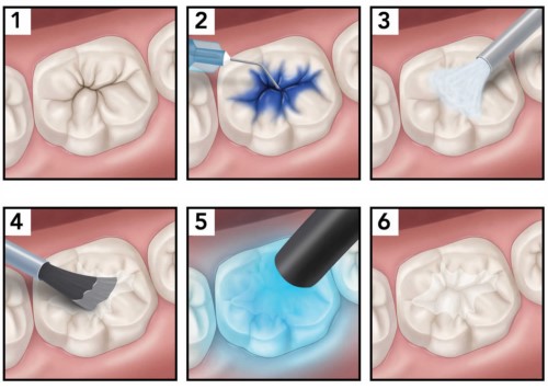 Răng sâu gần hết răng có trám được không? Nha Khoa Cần Thơ