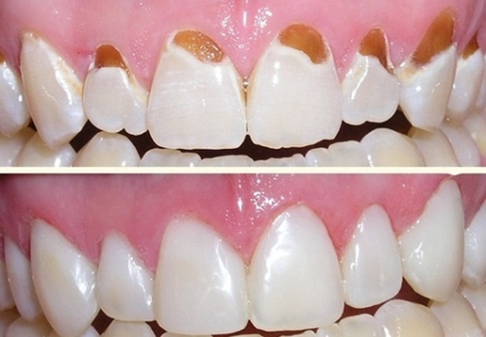 Ăn mòn răng và phục hồi men răng