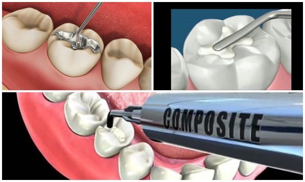 Trám răng composite | Giải pháp trám răng an toàn