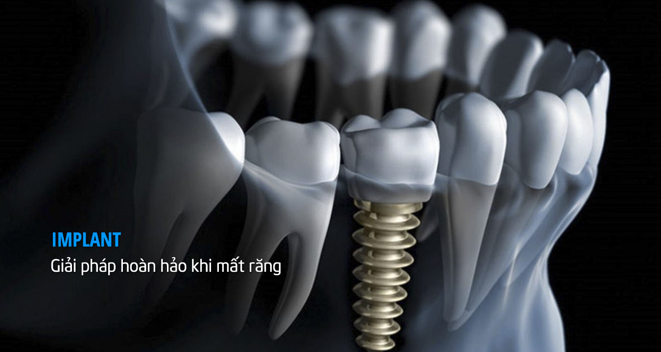 Tôi bị mất 1 răng trồng implant có được không? Cấy Implant Cần Thơ
