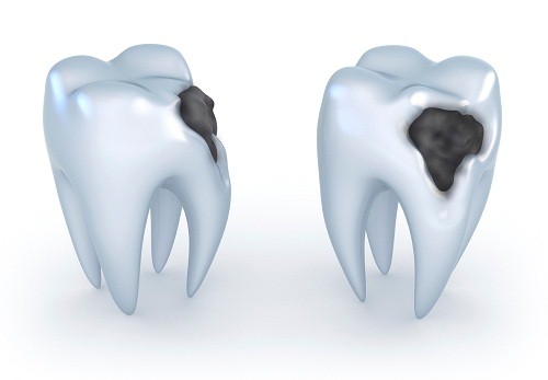 Các giai đoạn viêm tủy răng | Nha khoa Cần Thơ