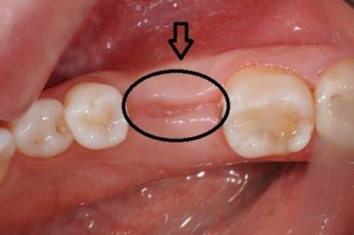 Thời gian lành vết thương sau khi nhổ răng? Nhổ răng Cần Thơ