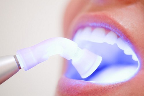 Cách Giúp Răng Giảm Ê Buốt Sau Khi Tẩy Trắng Răng