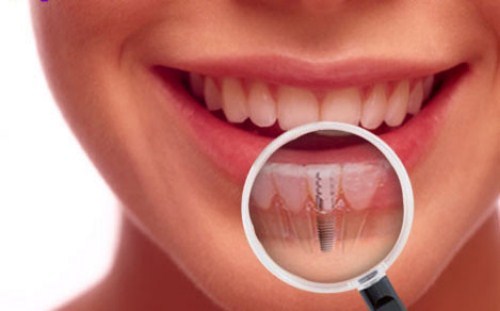 Nhổ răng sau thời gian bao lâu thì trồng lại được | Nhổ răng Cần Thơ