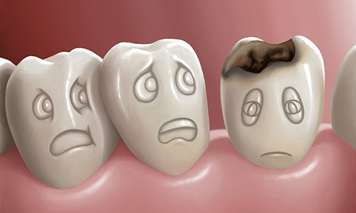 Biến Chứng Của Bệnh Sâu Răng | Nha Khoa Cần Thơ