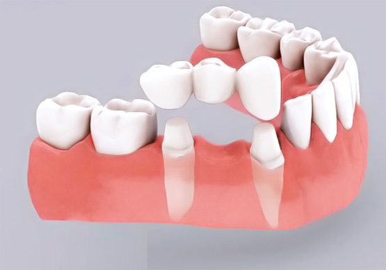 Phương pháp trồng răng sứ bắc cầu | Răng sứ Cần Thơ
