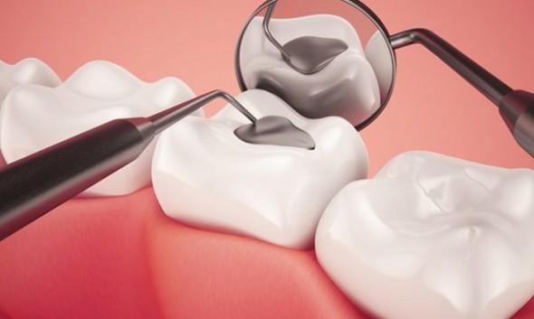 Trám răng có bền không | Trám răng thẩm mỹ Cần Thơ