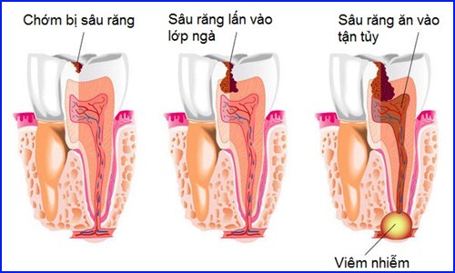 Sâu Răng Có Gây Hại Cho Tủy Răng | Nha Khoa Cần Thơ