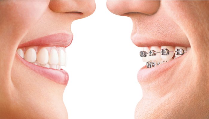 Quy trình chỉnh hình răng tại Nha khoa Cần Thơ