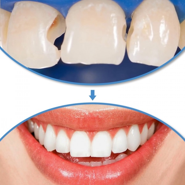 Phương pháp trám răng làm khít răng thưa | Trám răng thẩm mỹ Cần Thơ