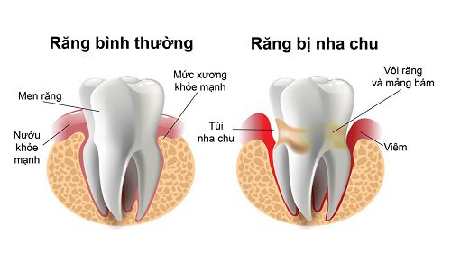 Bệnh viêm nha chu có tẩy trắng răng được không? Tẩy trắng răng Cần Thơ