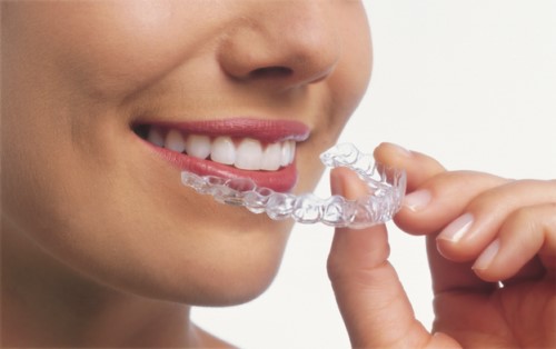 Máng chống nghiến răng | Nha khoa Cần Thơ