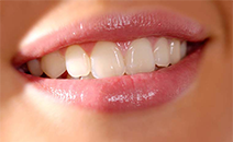 Điều trị hở nướu kết hợp răng sứ thẩm mỹ Cần Thơ