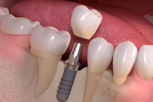 Những cách trồng răng nguyên hàm hiệu quả | Nha khoa Cần Thơ