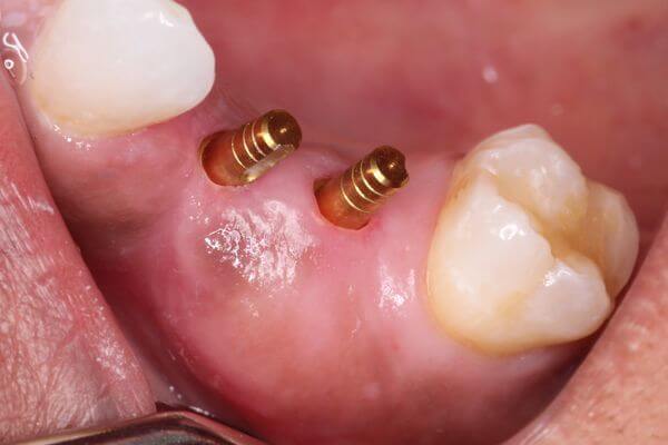 Cấy mini implant - Giải pháp tối ưu khi mất răng - Implant Cần Thơ