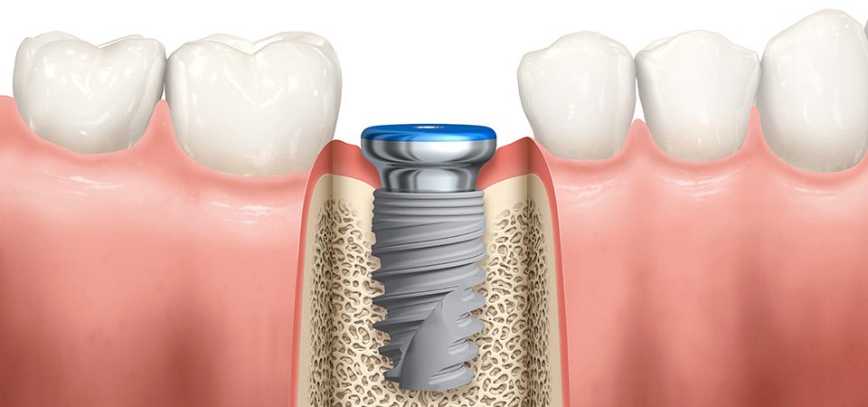 Phương pháp trồng răng cố định | Implant Cần Thơ