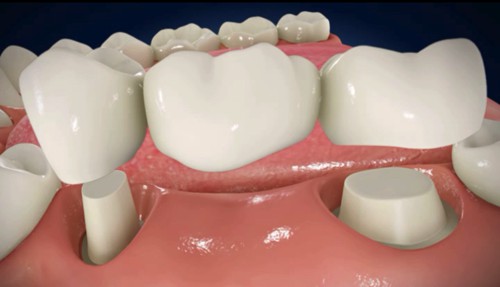 Răng sứ Cần Thơ | Nên làm cầu răng sứ trong những trường hợp nào?