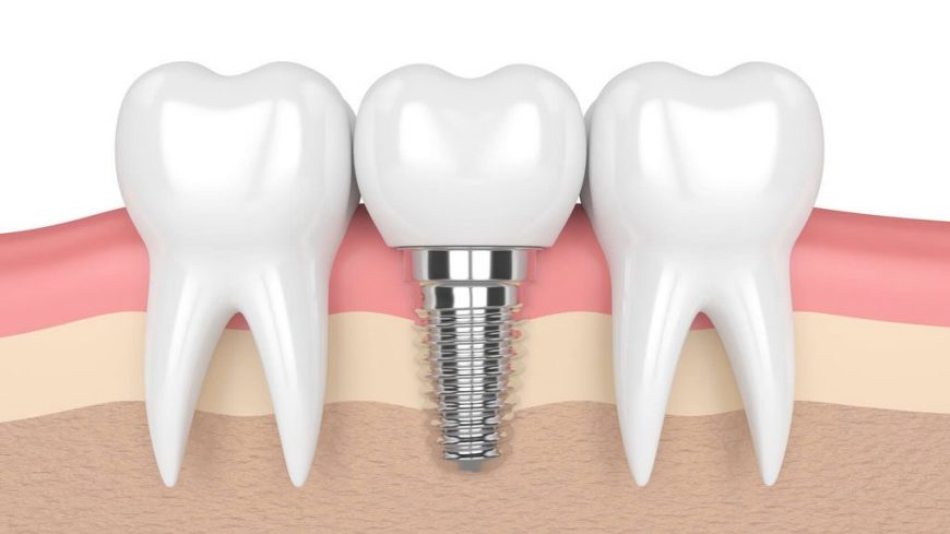 Trồng răng Implant mất bao lâu? Implant Cần Thơ
