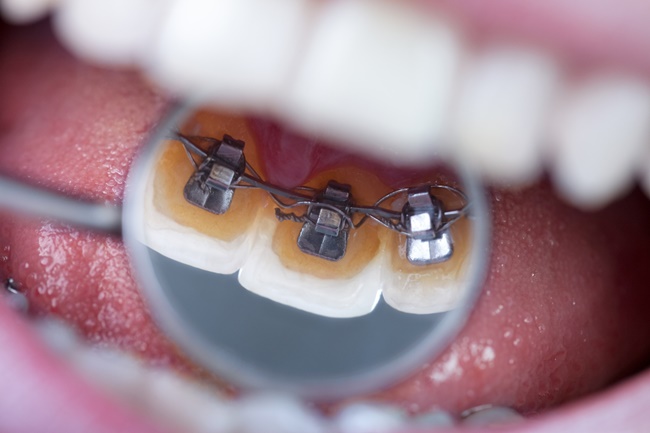 Phương pháp niềng răng mặt trong | Chỉnh hình răng Cần Thơ