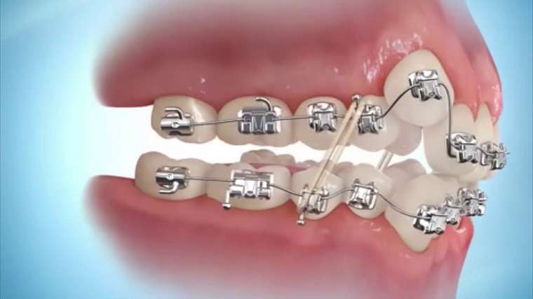 Mất răng gây ra hậu quả như thế nào? Nha khoa Cần Thơ