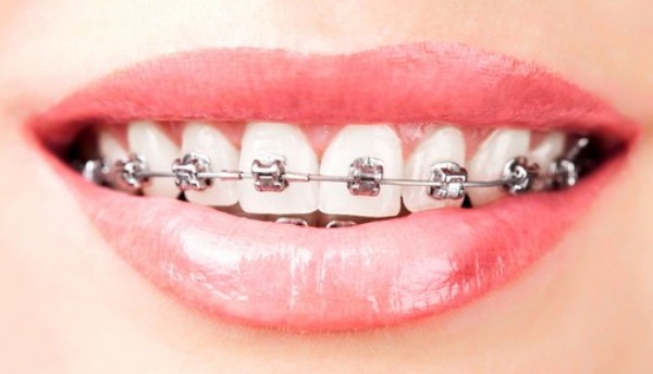 Lợi ích niềng răng | Niềng răng Cần Thơ