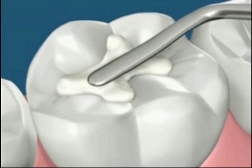 Tại sao răng bị tê buốt sau khi trám | Trám răng Cần Thơ